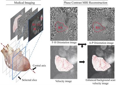 A Hybrid Approach for Cardiac Blood Flow Vortex Ring Identification Based on Optical Flow and Lagrangian Averaged Vorticity Deviation